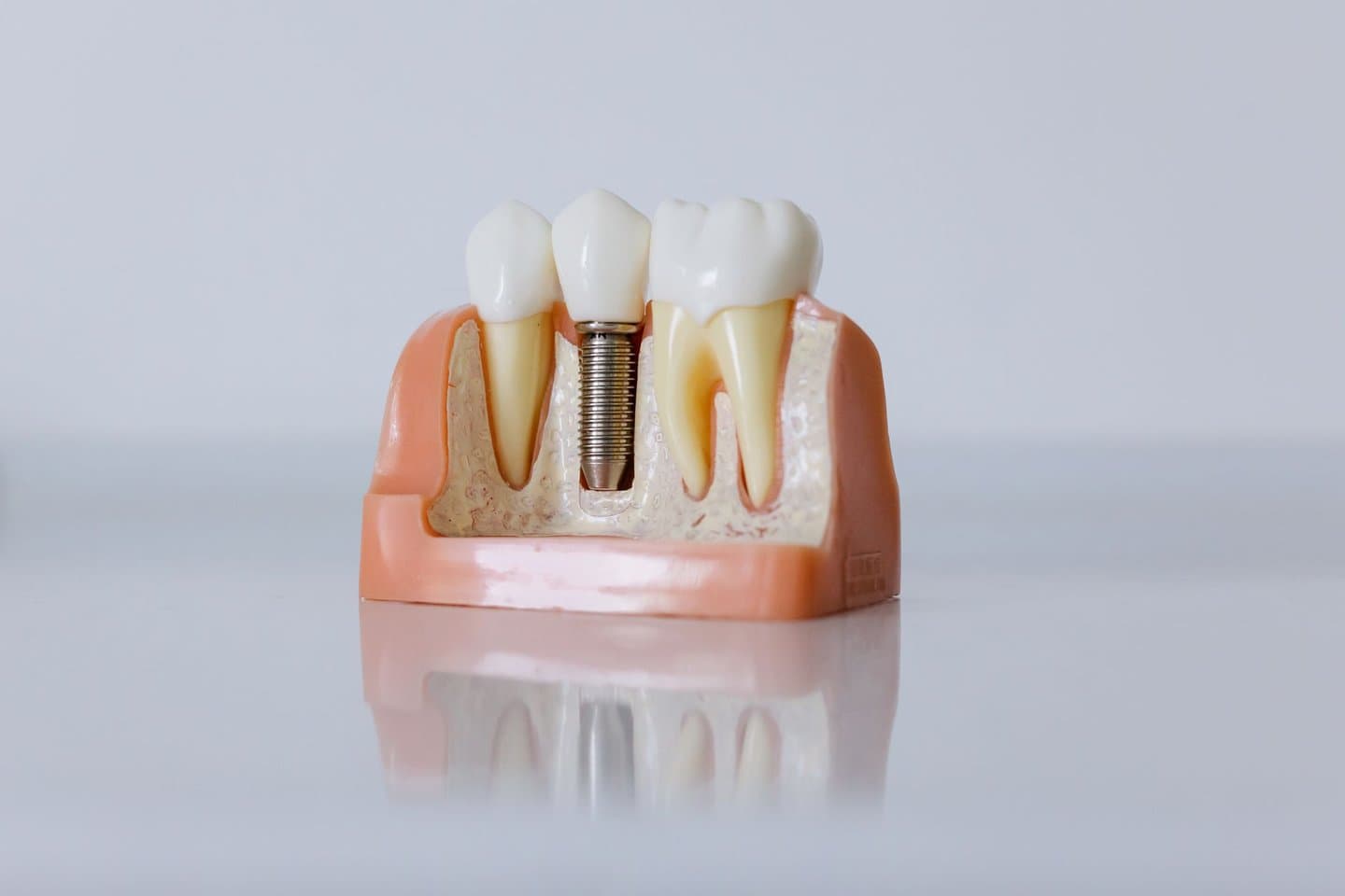 A cross-section dental model showing how a dental implant is placed in the jaw