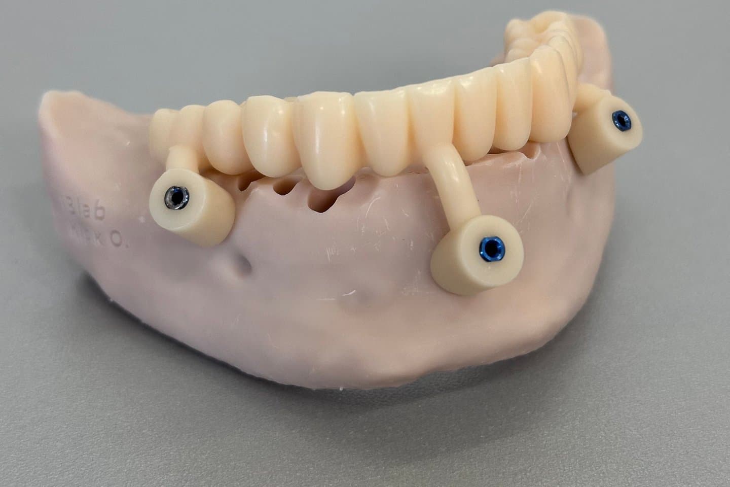A lab model showing how dental implants are placed in the jawbone, with three implant screws and a fixed dental bridge on top