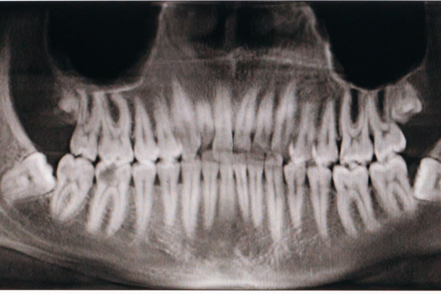 A panoramic dental X-ray showing the upper and lower jaw, all teeth, and the jawbone