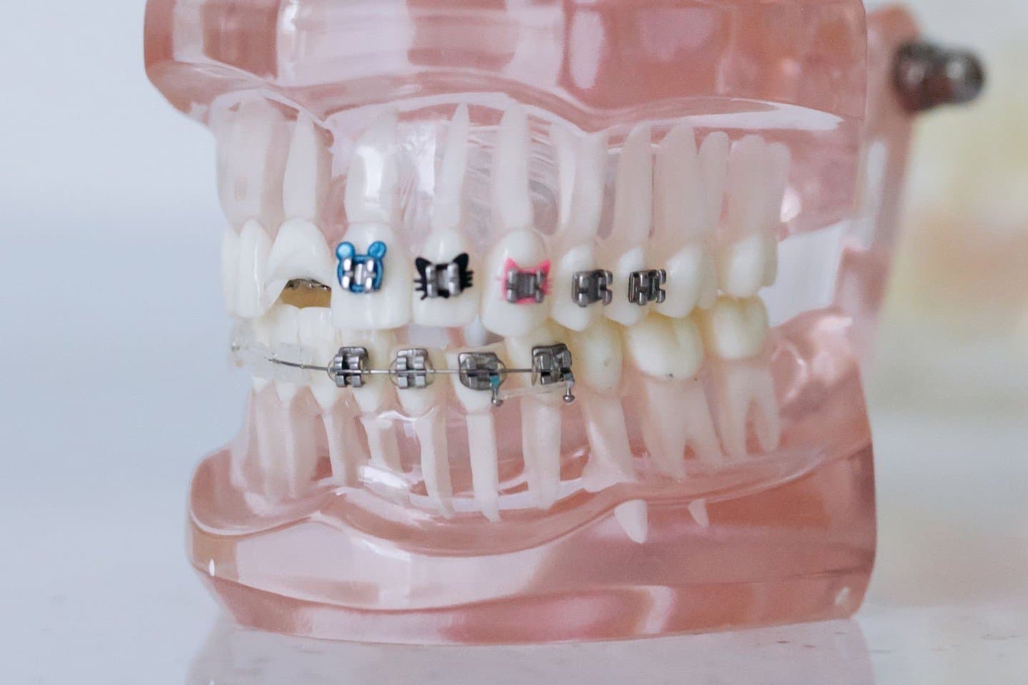 An orthodontic teaching model showing different types of brackets