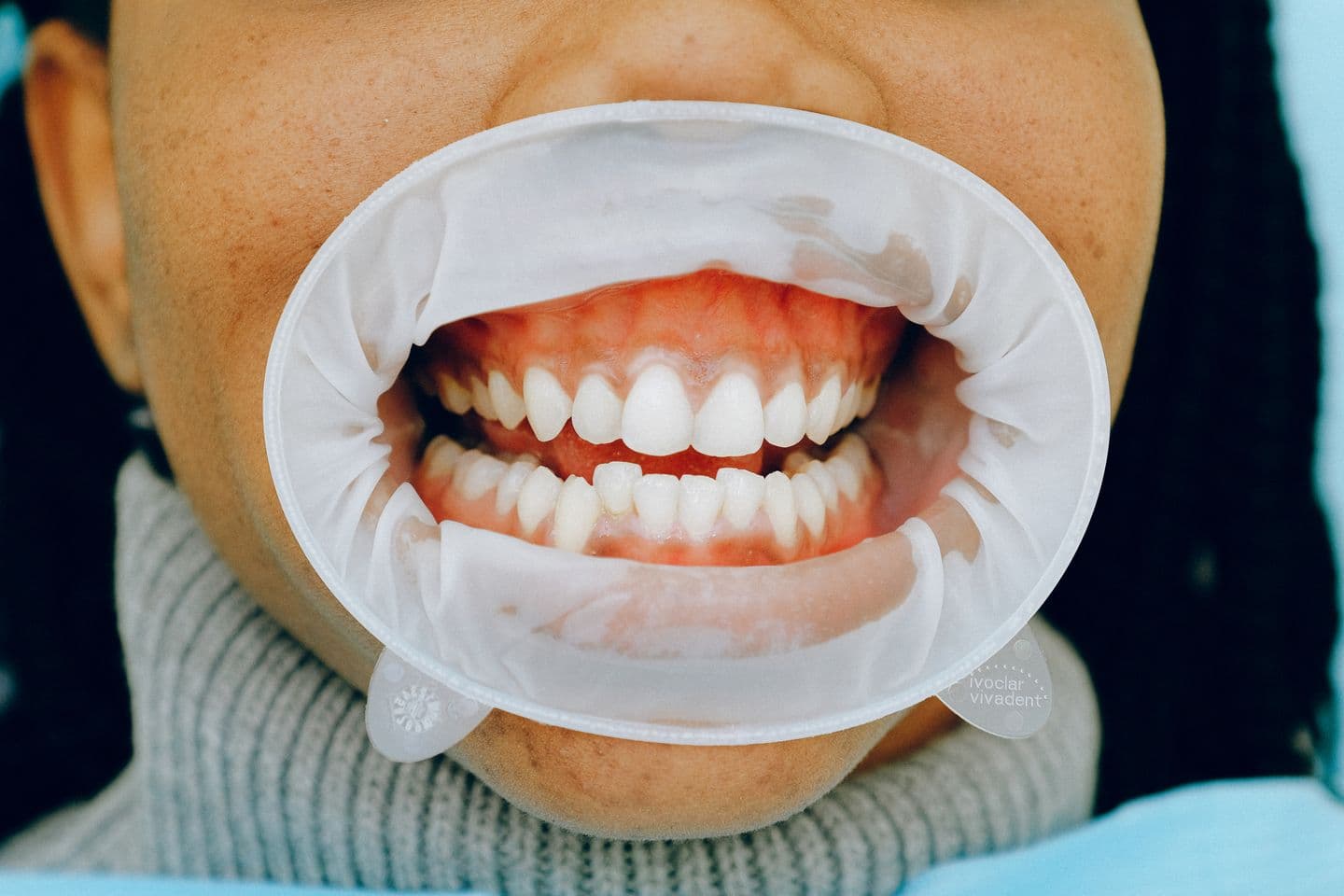 Gum Aesthetics