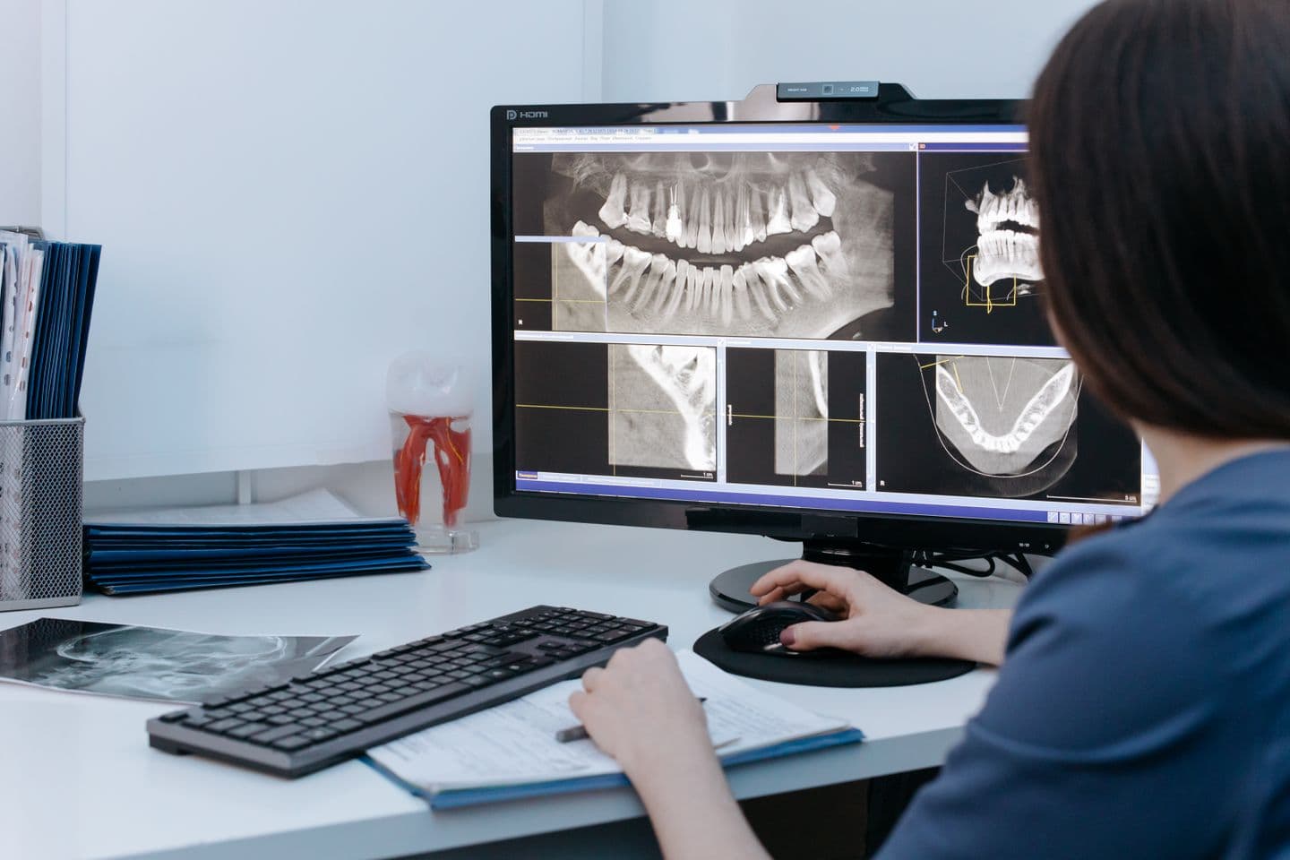 Wisdom Tooth Extraction